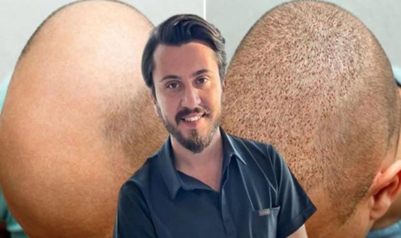 Saç ekimi için tercih Ankara!