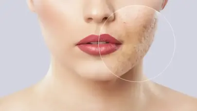 Sivilce izleri nasıl geçer? Dermatologlar açıkladı!