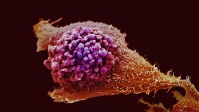 Prostat kanseri taramasında devrim: Yeni test alternatifi!