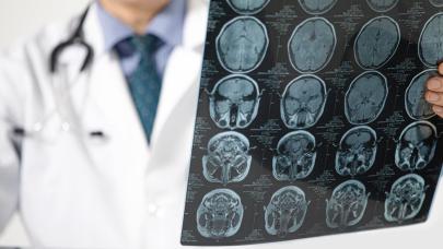 Genetik kodda gizli tehlike: Erkeklerde demans riski yükseliyor